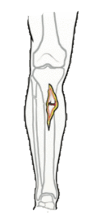 Grade II open fracture clinical illustration